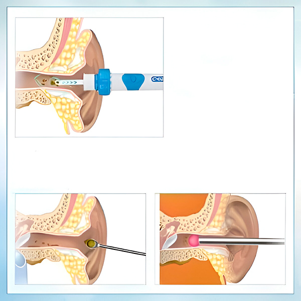 EarClean Pro™ – Hellävarainen korvavahanpoistaja imulla ja värinällä