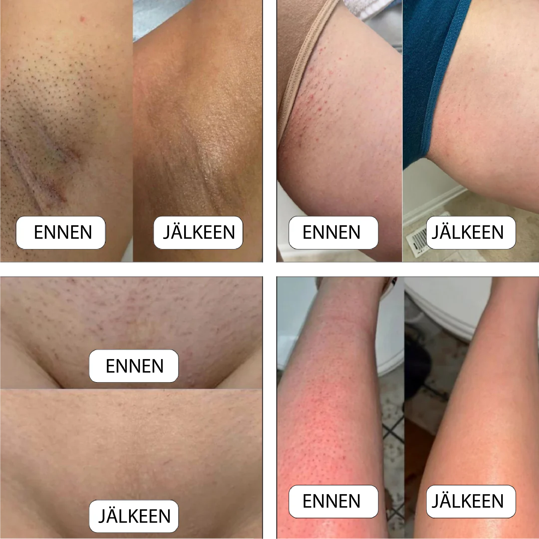 #Solys SmoothShave Ihokarvanpoistaja