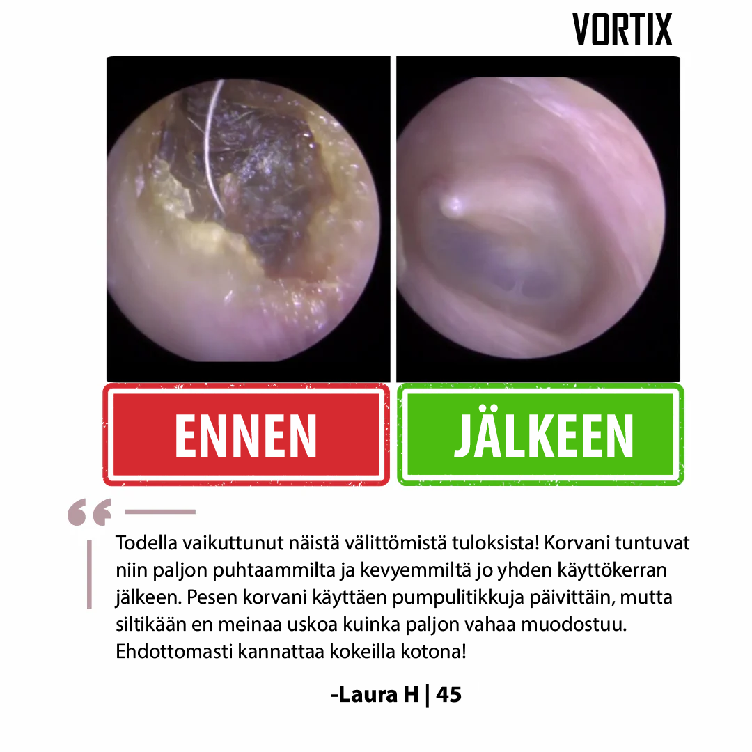 VORTIX sähkökäyttöinen laite korvavahan poistoon